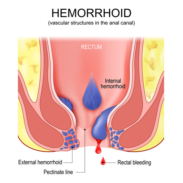 What Are Hemorrhoids?