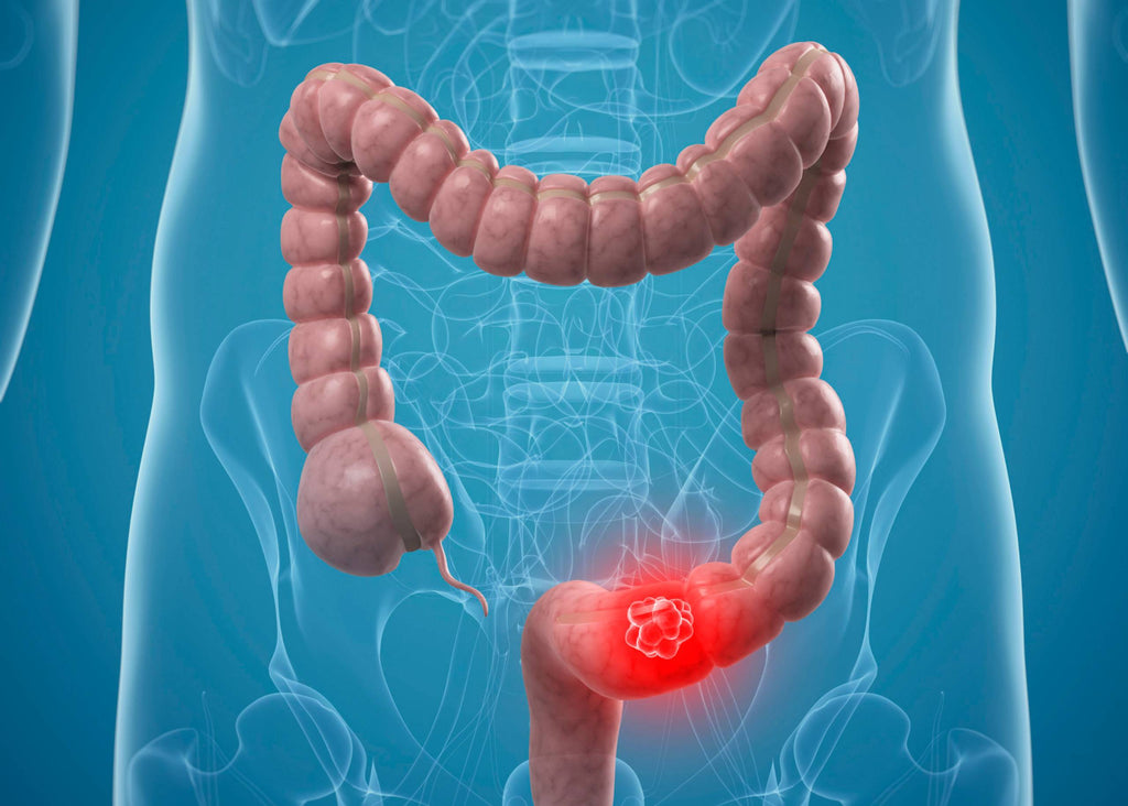 Do Hemorrhoids Increase the Risk of Colon Cancer?