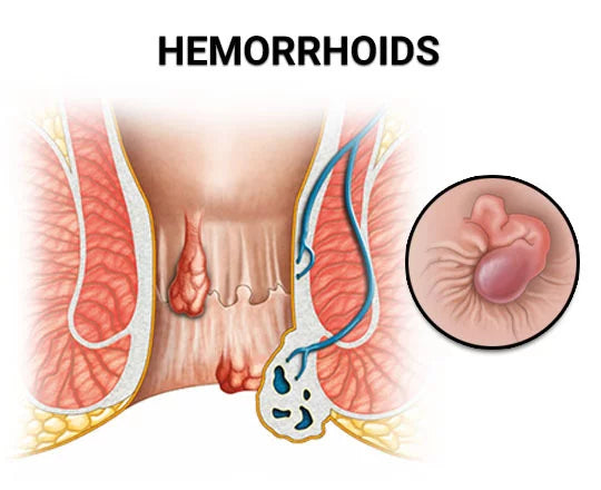 Psychological Effects of Chronic Hemorrhoids