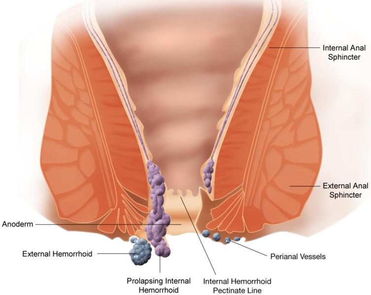 how to deal with hemorrhoids