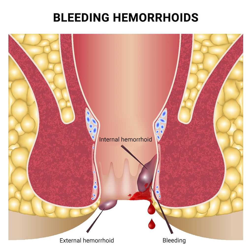 Is a Ruptured Hemorrhoid Dangerous