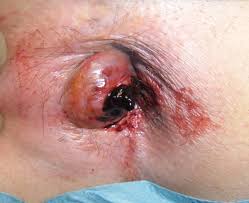 hemorrhoid burst