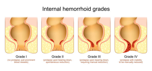 How Long Do Hemorrhoids Last?