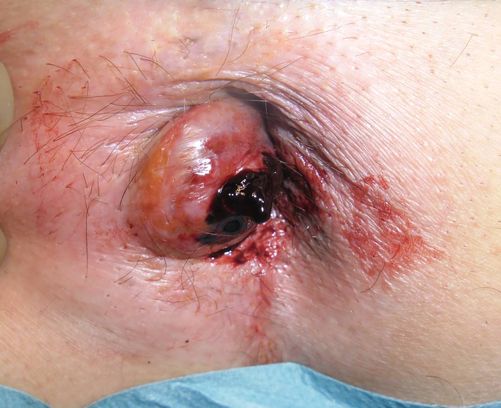 what do hemorrhoids look like